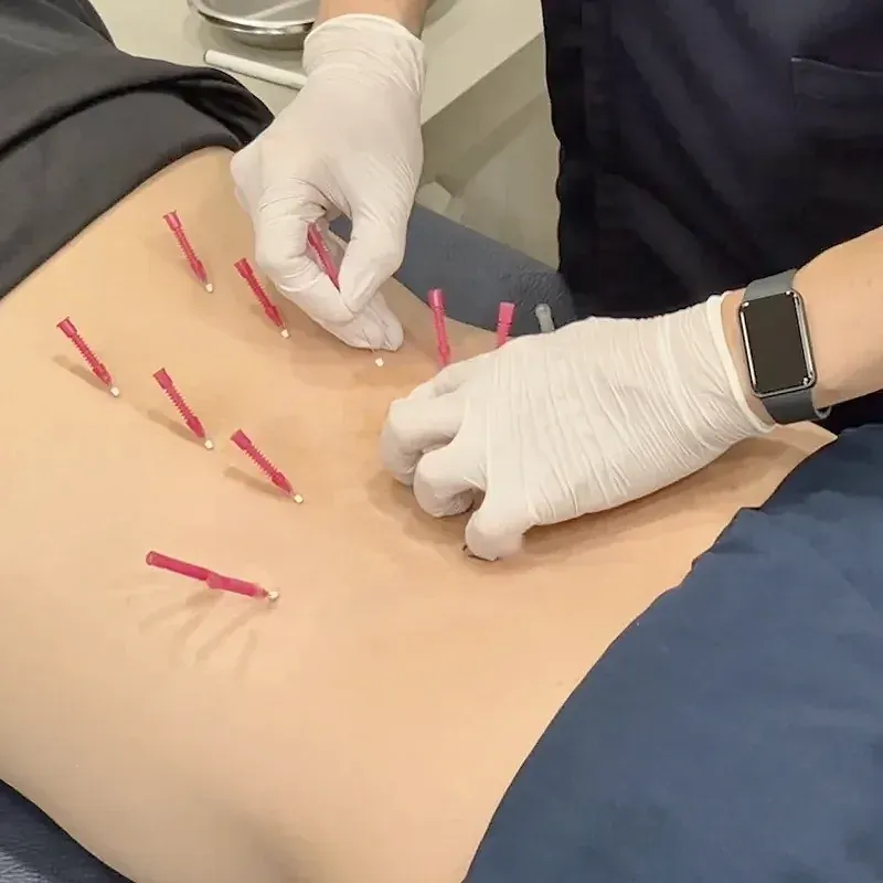 엎드린 환자의 허리에 매선 바늘 여러 개를 꽂으며 장갑 낀 손으로 매선치료를 하는 장면