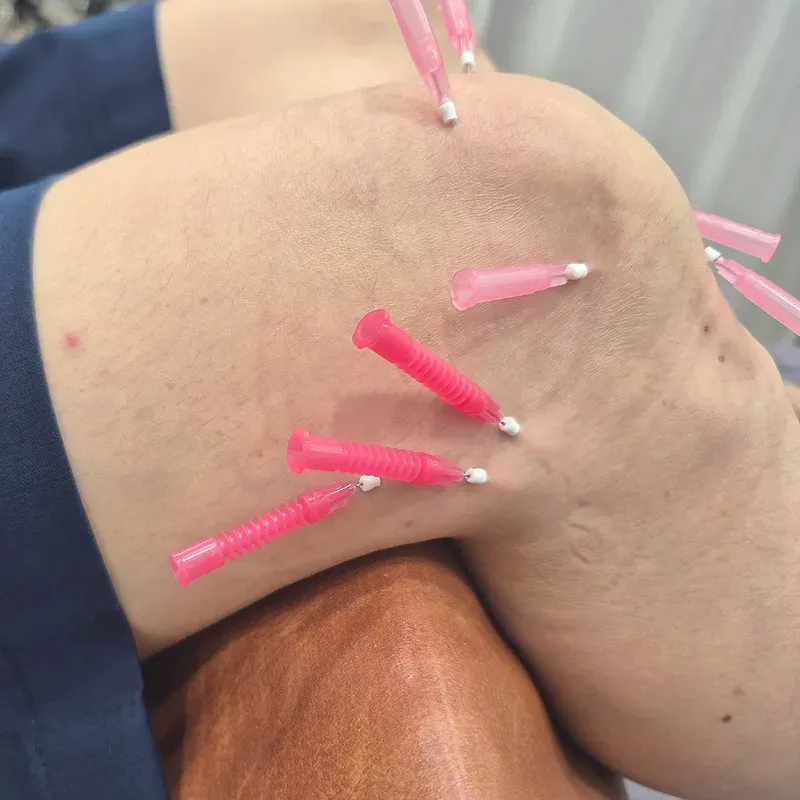 무릎 둘레에 분홍 매선 바늘 여러 개가 꽂힌 매선치료 장면
