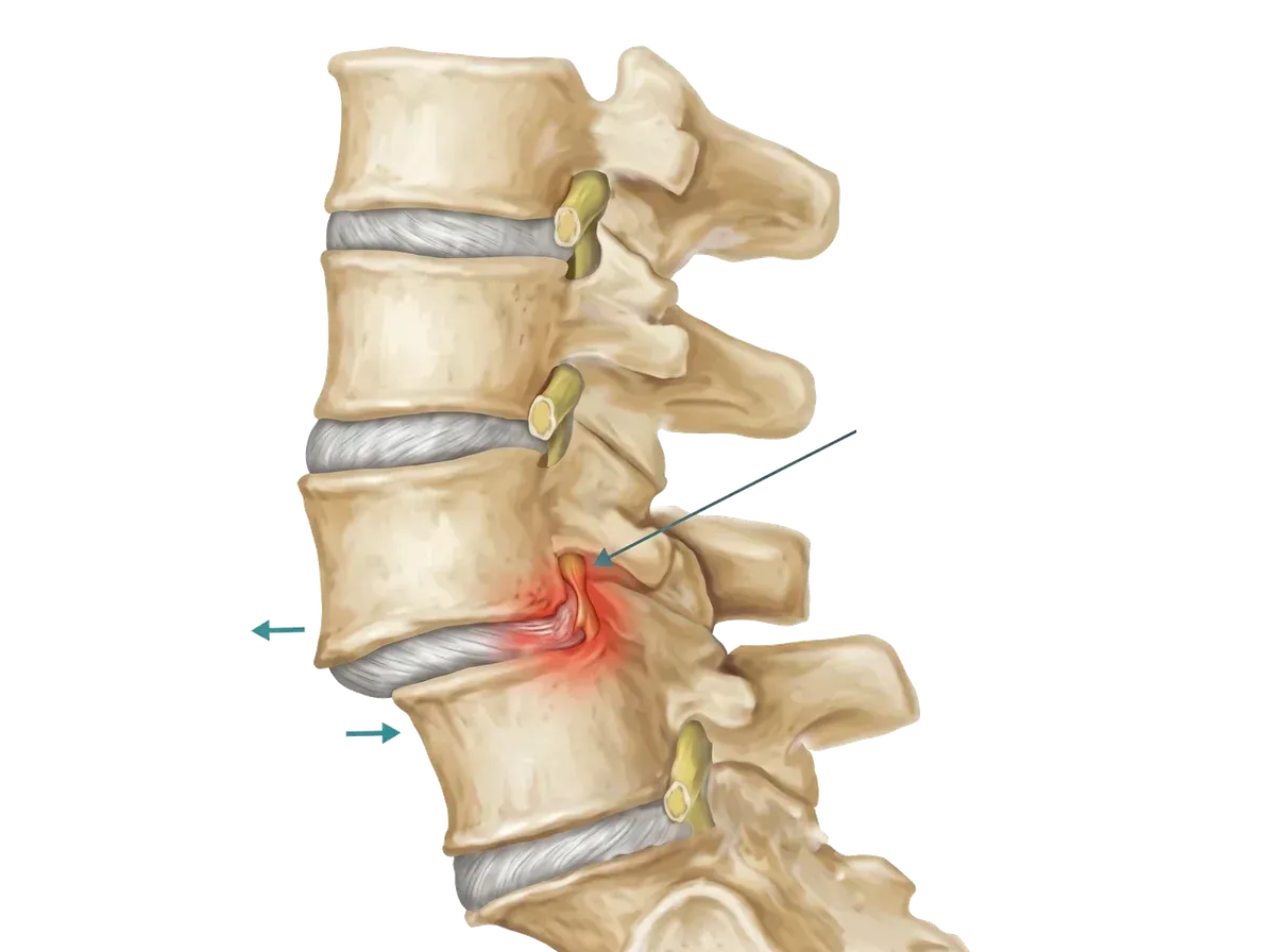 척추관협착증의 원인 중 척추전방전위증을 표현한 요추 측면도, 앞으로 밀려난 척추뼈와 그 사이에서 눌린 신경 부위가 붉게 표시됨