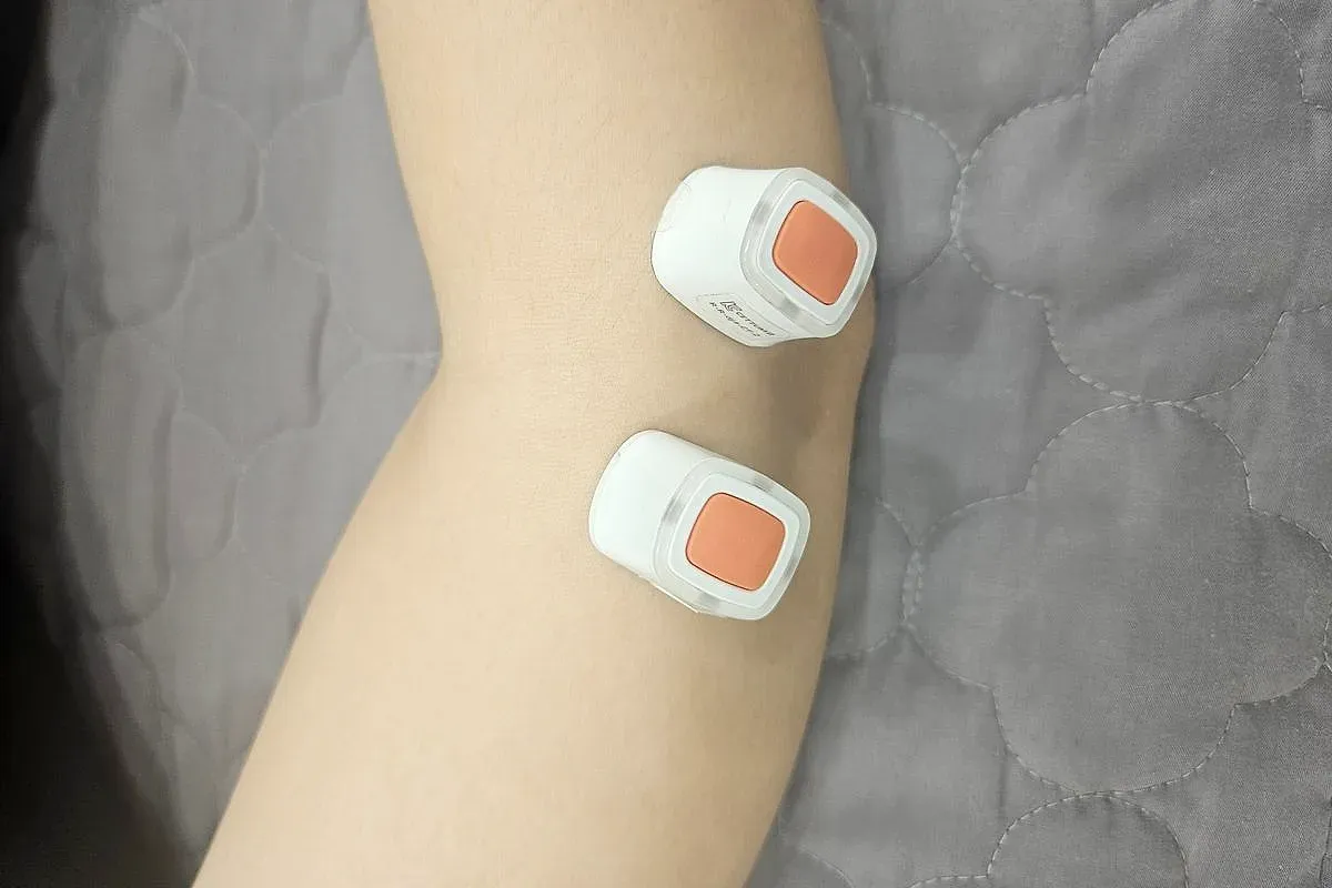 팔꿈치 안쪽에 뜸 기구 두 개를 붙여 뜸치료를 하는 모습